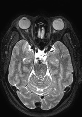Accessory middle cerebral artery (Radiopaedia 73114-83828 Axial T2 128).jpg