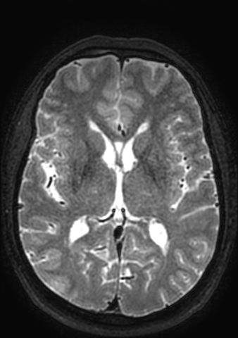Accessory middle cerebral artery (Radiopaedia 73114-83828 Axial T2 63).jpg