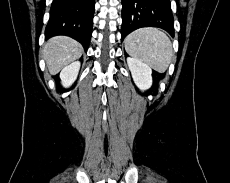 Accessory right inferior hepatic vein (Radiopaedia 75207-86305 Coronal C+ portal venous phase 70).jpg