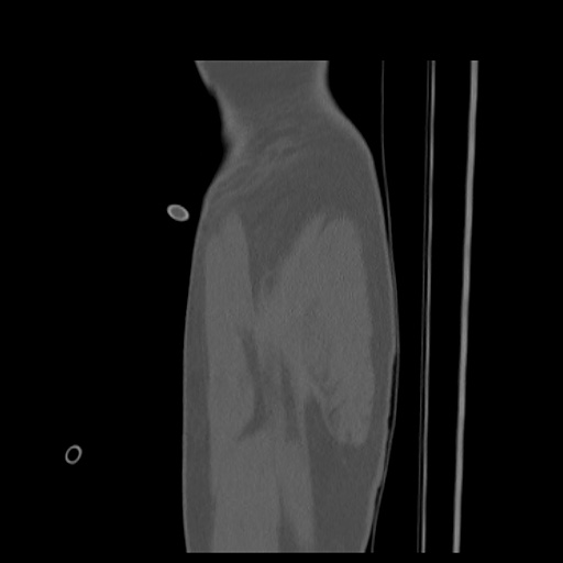Acetabular and ilial fractures (Radiopaedia 59084-66378 Sagittal bone window 2).jpg
