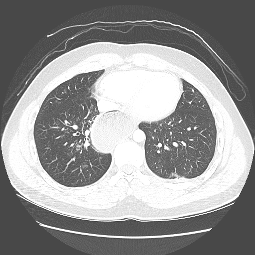 Achalasia (Radiopaedia 52507-58417 Axial lung window 44).jpg