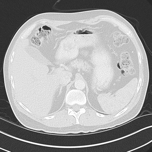 File:Achalasia of the cardia (Radiopaedia 38497-40595 Axial lung window 52).png