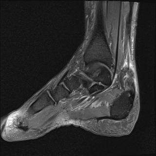 File:Achilles tendon tear (Radiopaedia 77615-89819 Sagittal PD fat sat 8).jpg