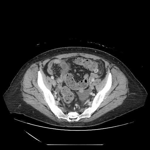 Acinar cell carcinoma of the pancreas (Radiopaedia 75442-86669 Axial C+ portal venous phase 120).jpg