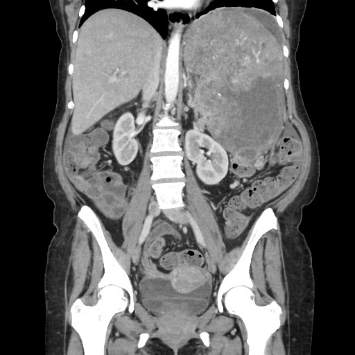 Acinar cell carcinoma of the pancreas (Radiopaedia 75442-86669 Coronal C+ portal venous phase 72).jpg
