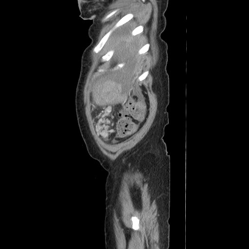Acinar cell carcinoma of the pancreas (Radiopaedia 75442-86669 Sagittal C+ portal venous phase 175).jpg