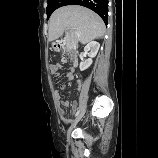 Acinar cell carcinoma of the pancreas (Radiopaedia 75442-86669 Sagittal C+ portal venous phase 72).jpg