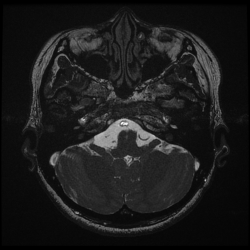 File:Acoustic neuroma (Radiopaedia 34049-35283 Axial 39).png