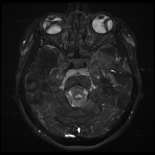 Acoustic neuroma (Radiopaedia 34049-35283 Axial 83).png