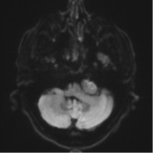 Acoustic schwannoma (Radiopaedia 55729-62281 E 31).png