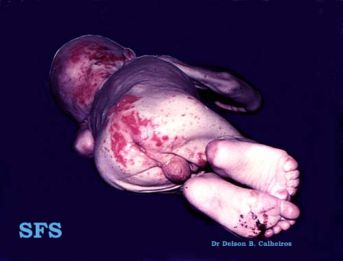 Acrodermatitis Enteropathica (Dermatology Atlas 3).jpg