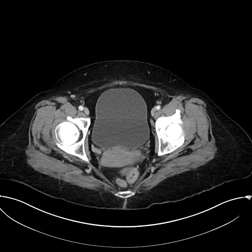 Active Crohn disease (Radiopaedia 59394-66750 Axial C+ portal venous phase 66).jpg