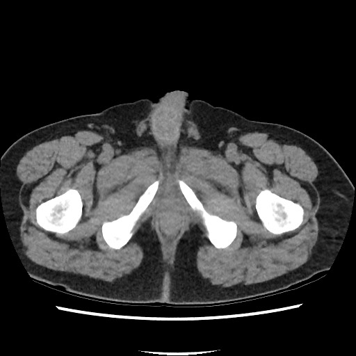 Active colonic bleed on CT (Radiopaedia 49765-55025 Axial non-contrast 89).jpg