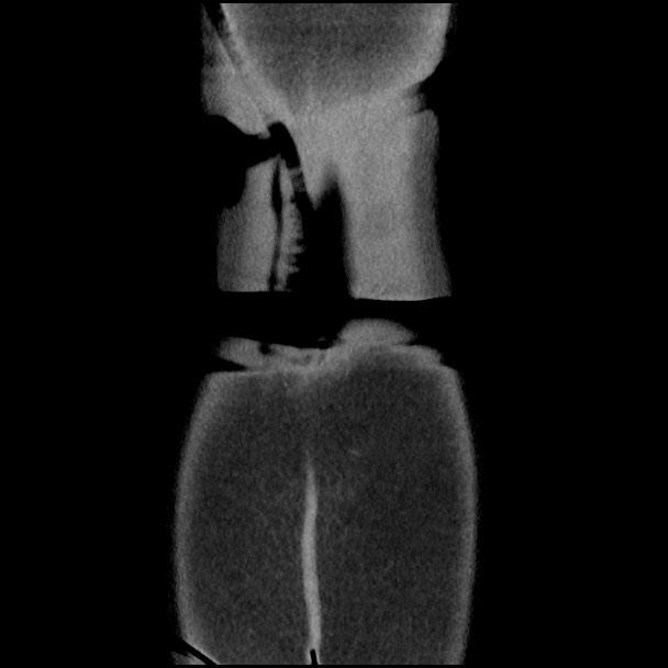 Active colonic bleed on CT (Radiopaedia 49765-55025 Coronal non-contrast 55).jpg