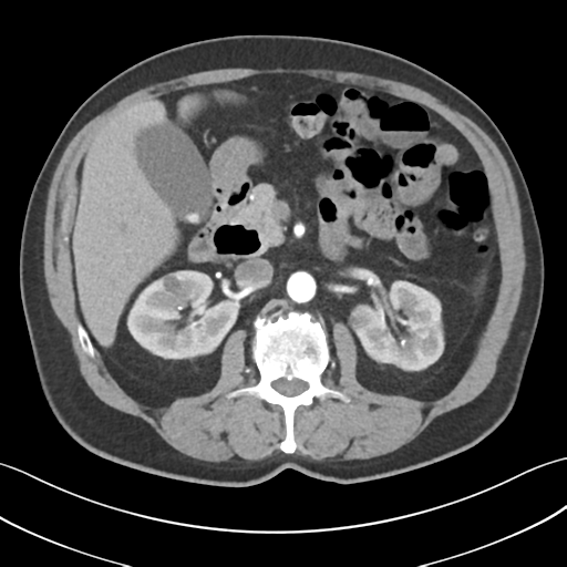 File:Active diverticular hemorrhage (Radiopaedia 39415-41725 Axial C+ arterial phase 24).png