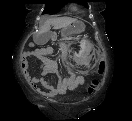 Active renal extravasation with large subcapsular and retroperitoneal hemorrhage (Radiopaedia 60975-68796 Coronal C+ arterial phase 49).jpg