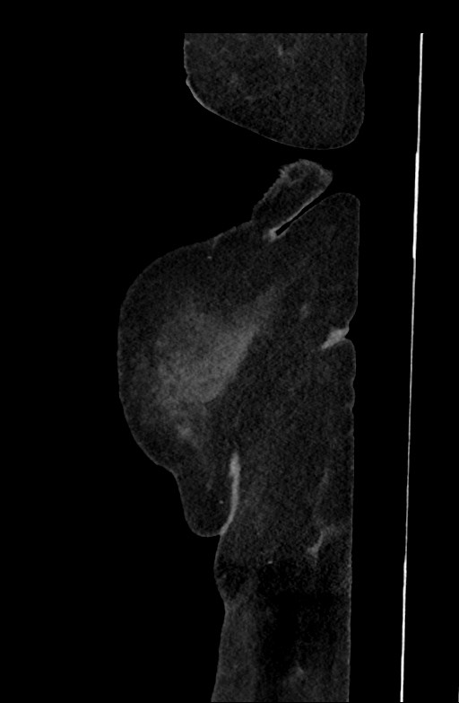 Active renal extravasation with large subcapsular and retroperitoneal hemorrhage (Radiopaedia 60975-68796 Sagittal C+ portal venous phase 212).jpg