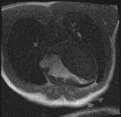 File:Active right ventricular cardiac sarcoidosis (Radiopaedia 55596-62100 Axial Dynamic perfusion scan MOCO 33).jpg