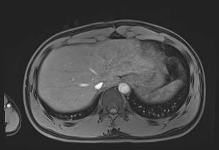 Active right ventricular cardiac sarcoidosis (Radiopaedia 55596-62100 Axial Post contrast Dixon 70).jpg