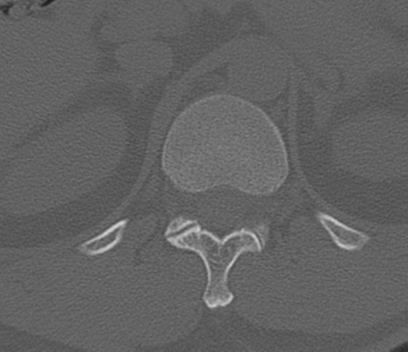 File:Acute L1 burst compression fracture (Radiopaedia 34430-35755 Axial bone window 4).png