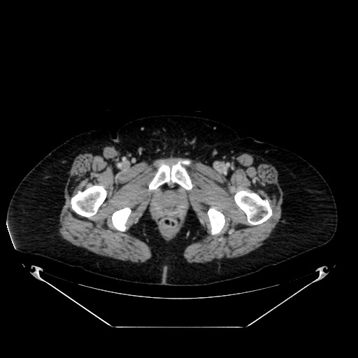 Acute appendicitis, heterotaxy syndrome (Radiopaedia 66884-76202 Axial C+ portal venous phase 133).jpg