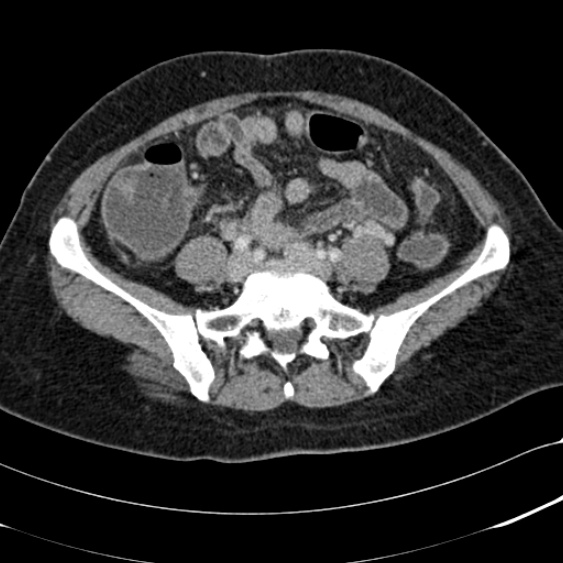 File:Acute appendicitis (Radiopaedia 48792-53822 Axial C+ portal venous phase 79).jpg