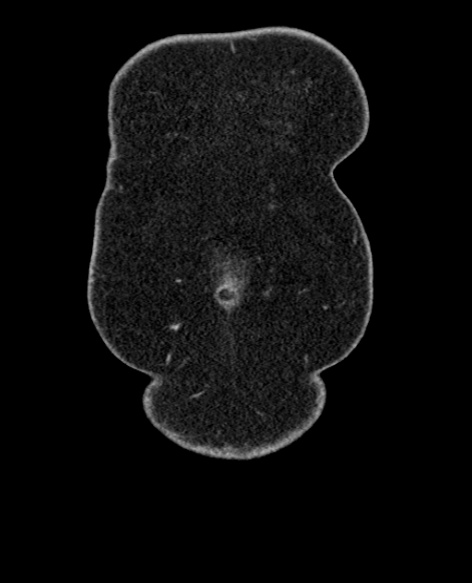 File:Acute appendicitis (Radiopaedia 48792-53822 Coronal C+ portal venous phase 7).jpg