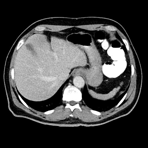 File:Acute appendicitis (Radiopaedia 77016-88960 Axial C+ portal venous phase 29).jpg