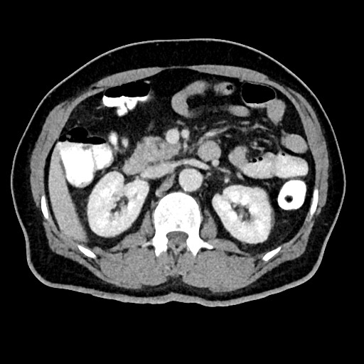 Acute appendicitis (Radiopaedia 77016-88960 Axial C+ portal venous phase 56).jpg