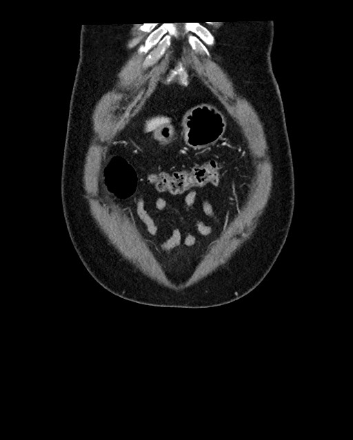 Acute appendicitis - large appendicoliths (Radiopaedia 61805-69820 Coronal C+ portal venous phase 20).jpg