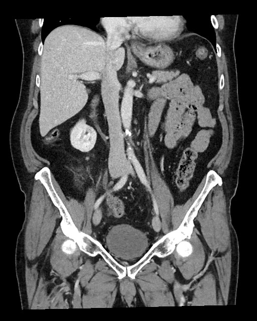Acute appendicitis - large appendicoliths (Radiopaedia 61805-69820 Coronal C+ portal venous phase 67).jpg