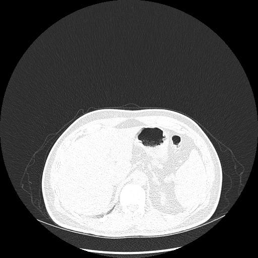 Acute appendicitis and COVID 19 pneumonia (Radiopaedia 76604-88380 Axial lung window 55).jpg