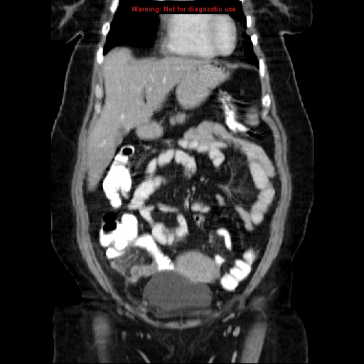 Acute appendicitis complicated by ovarian vein thrombophlebitis (Radiopaedia 16172-15851 Coronal C+ portal venous phase 27).jpg