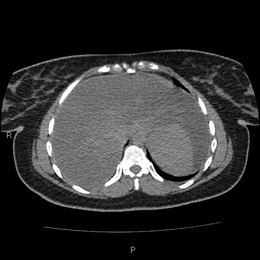 Acute bilateral pyelonephritis (Radiopaedia 37146-38881 Axial non-contrast 14).jpg