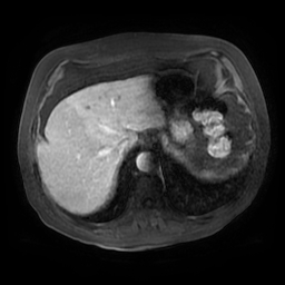 Acute cholecystitis complicated by pylephlebitis (Radiopaedia 65782-74915 Axial arterioportal phase T1 C+ fat sat 20).jpg