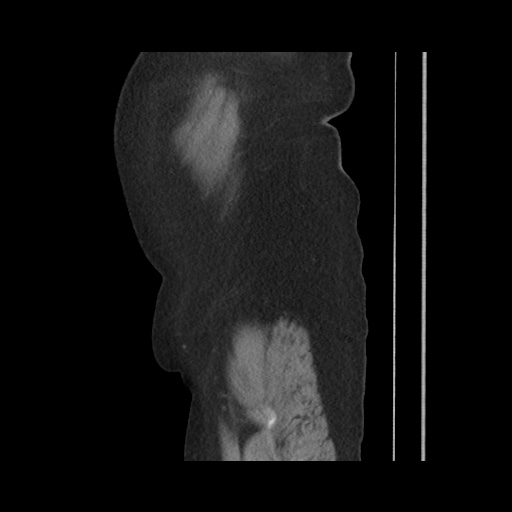 Acute cholecystitis with tensile fundus sign (Radiopaedia 71394-81723 Sagittal non-contrast 31).jpg