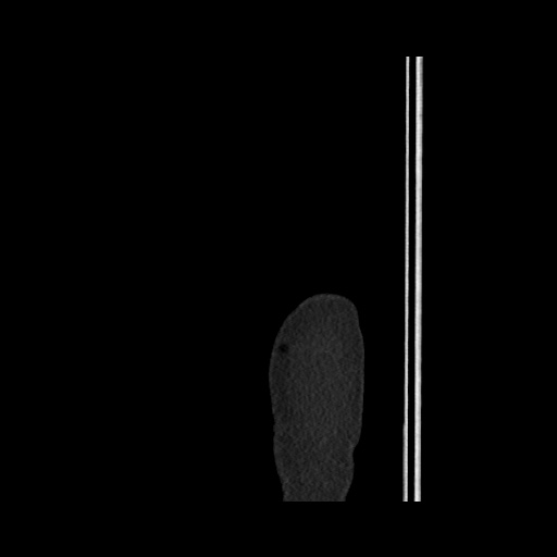 Acute cholecystitis with tensile fundus sign (Radiopaedia 71394-81723 Sagittal non-contrast 8).jpg