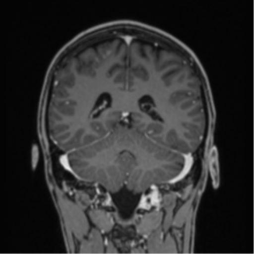 Acute disseminated encephalomyelitis (ADEM) (Radiopaedia 65319-74349 Coronal T1 C+ 9).png