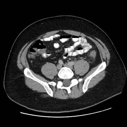 File:Acute diverticulitis with localized perforation (Radiopaedia 41296-44113 Axial C+ portal venous phase 62).jpg