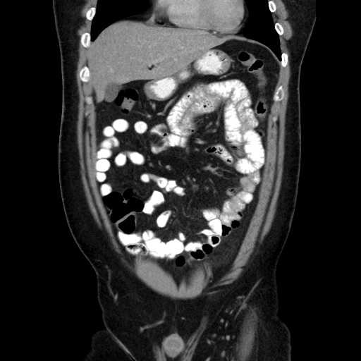 Acute diverticulitis with localized perforation (Radiopaedia 41296-44113 Coronal C+ portal venous phase 22).jpg