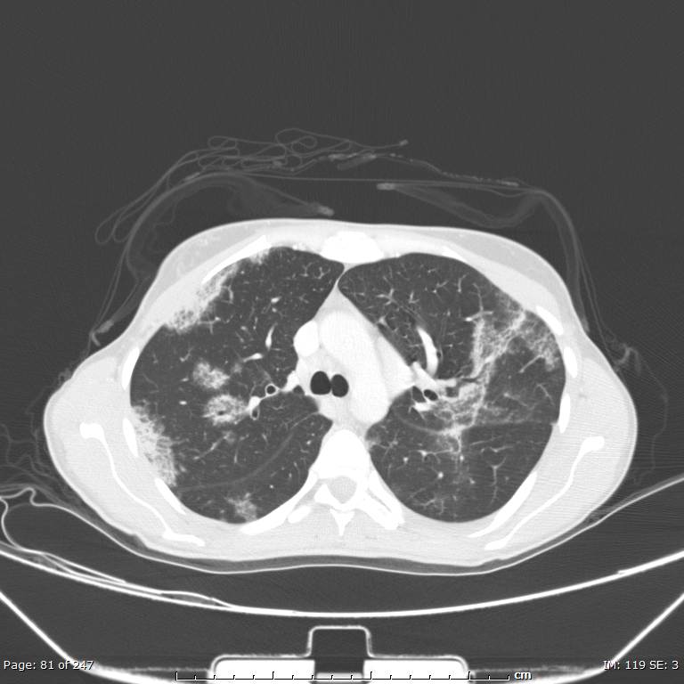 Acute eosinophilic pneumonia (Radiopaedia 48211-53073 Axial lung window 29).jpg