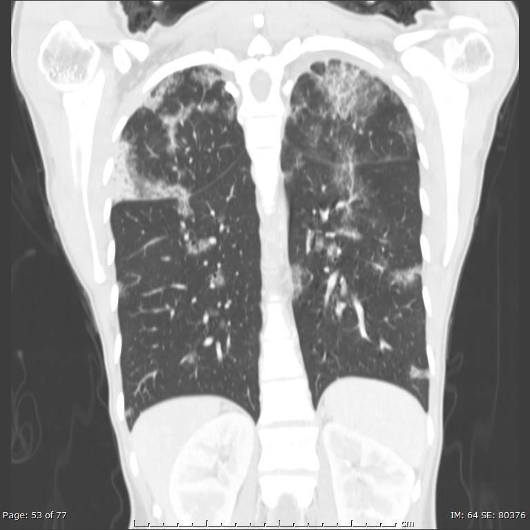 Acute eosinophilic pneumonia (Radiopaedia 48211-53073 Coronal lung window 36).jpg
