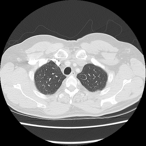 Acute epicardial fat necrosis (Radiopaedia 42327-45440 Axial lung window 15).jpg