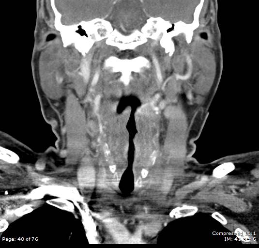 Acute epiglottitis (Radiopaedia 54375-60590 Coronal C+ arterial phase 40).jpg