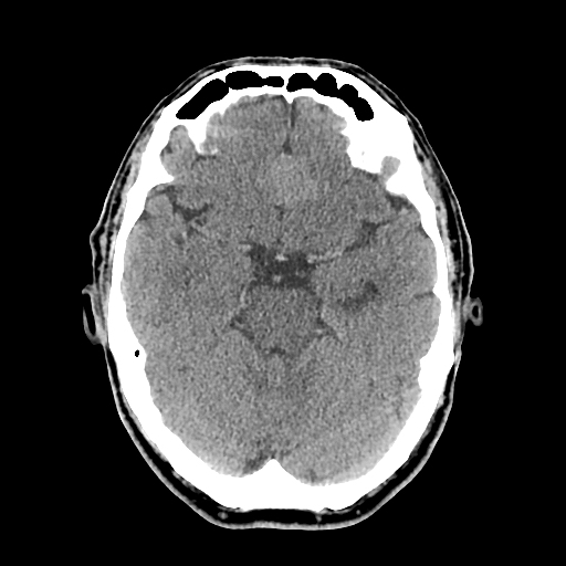 File:Acute hippocampal infarction (Radiopaedia 10610-11071 non-contrast 4).jpg