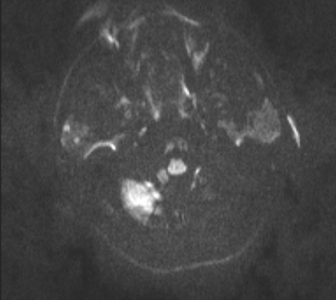Acute ischemic stroke - posterior circulation territory (Radiopaedia 77670-89880 Axial DWI 48).jpg