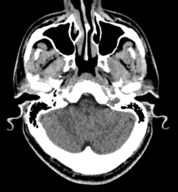 Acute ischemic stroke - posterior circulation territory (Radiopaedia 77670-89881 non-contrast 14).jpg