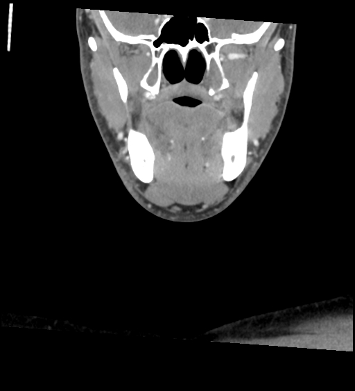 Acute longus colli calcific tendinitis (Radiopaedia 72495-83036 Coronal C+ arterial phase 11).jpg