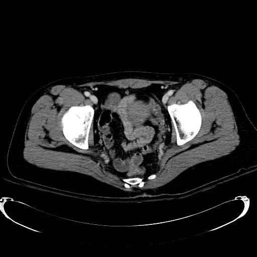 File:Acute myocardial infarction in CT (Radiopaedia 39947-42415 Axial C+ portal venous phase 121).jpg