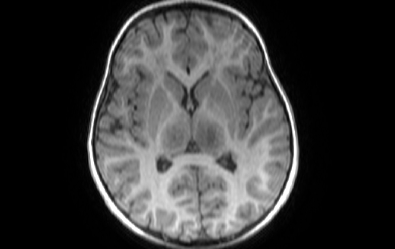 File:Acute necrotizing encephalitis of childhood (Radiopaedia 67356-76737 Axial T1 45).jpg